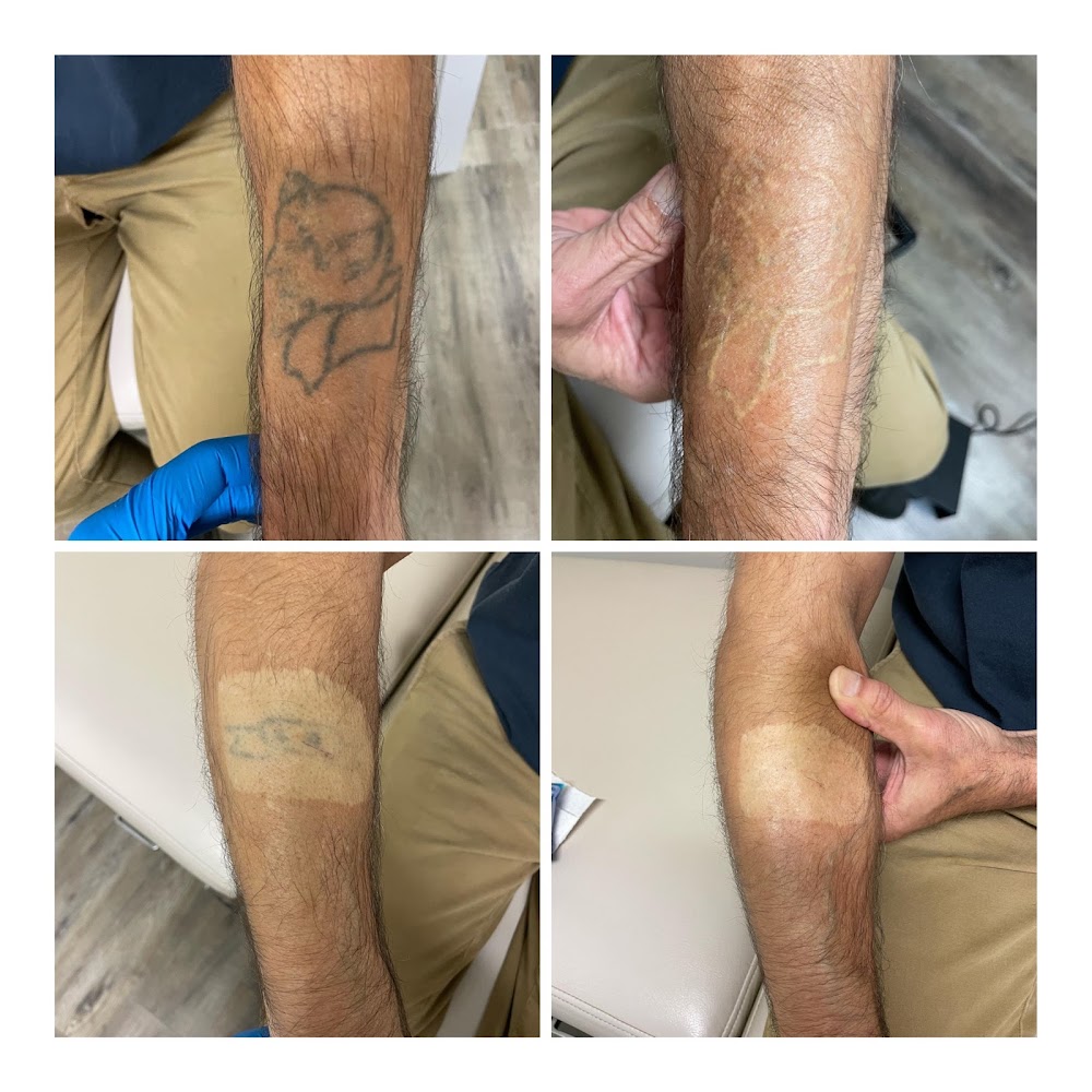 Coastline Laser Tattoo Removal